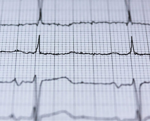 elettrocardiogramma Giornata mondiale del cuore